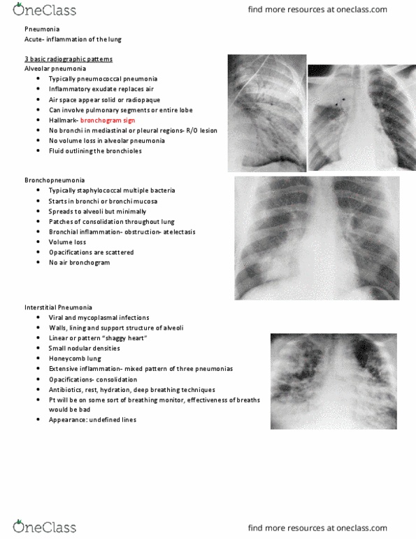 MEDRADSC 2I03 Lecture Notes - Lecture 10: Airway Obstruction, Mycobacterium Tuberculosis, Bacterial Pneumonia thumbnail