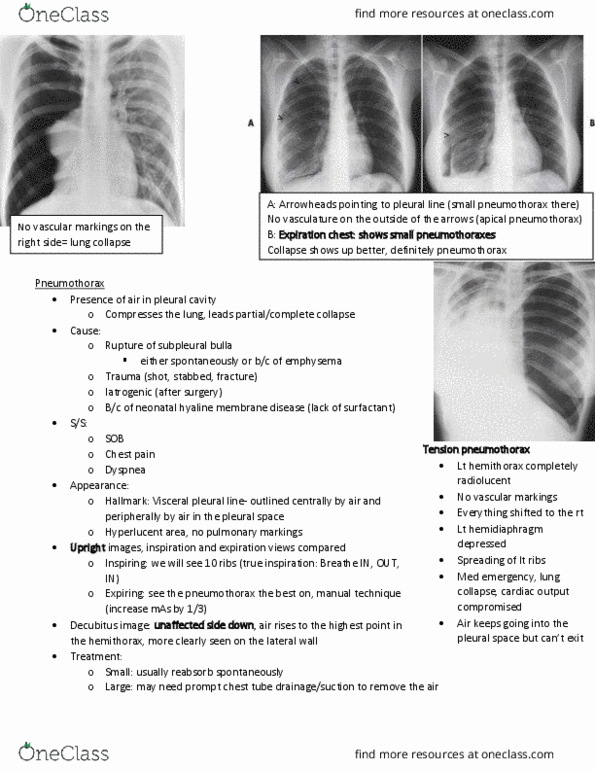 MEDRADSC 2I03 Lecture Notes - Lecture 12: Infant Respiratory Distress Syndrome, Costodiaphragmatic Recess, Chest Tube thumbnail