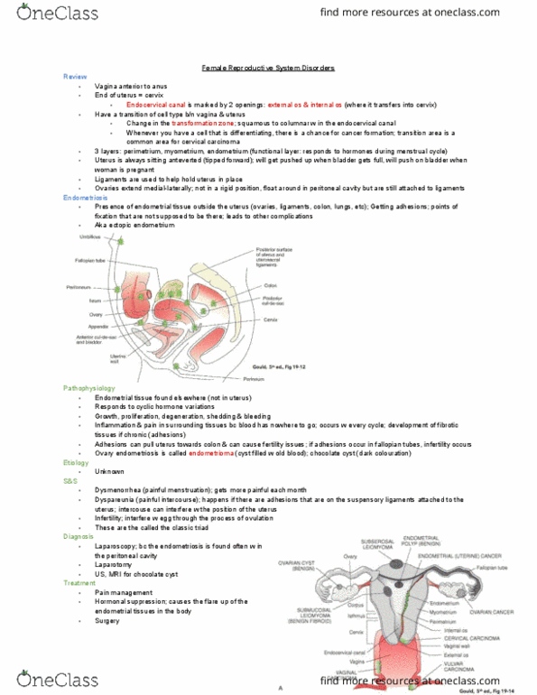 MEDRADSC 1B03 Lecture Notes - Lecture 17: Endometriosis Of Ovary, Endometriosis, Laparotomy thumbnail