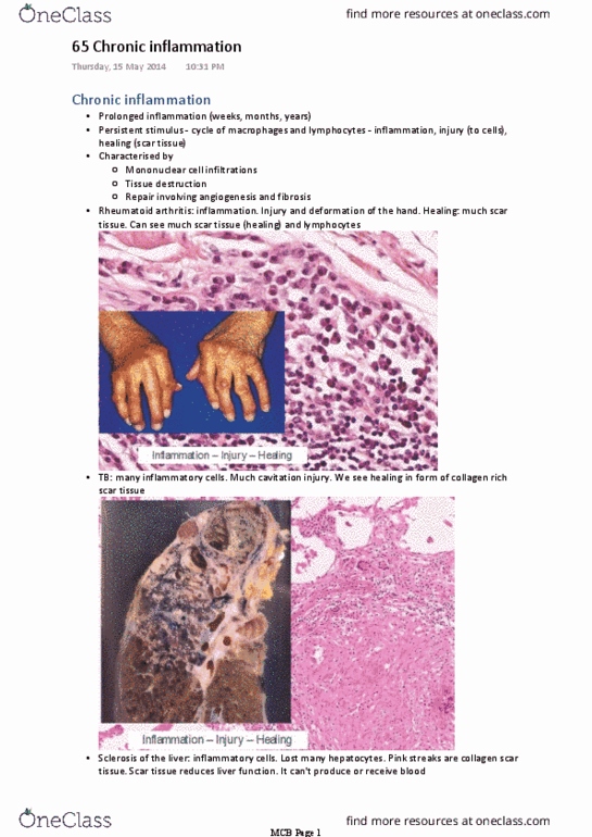 BIOM20001 Lecture Notes - Lecture 65: Peptic Ulcer, Atherosclerosis, Macrophage thumbnail