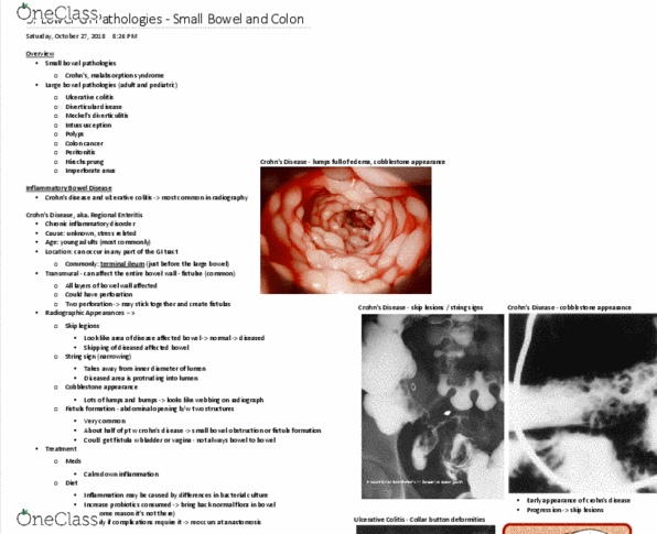 MEDRADSC 2I03 Lecture Notes - Lecture 9: Bowel Obstruction, Inflammatory Bowel Disease, Ulcerative Colitis thumbnail