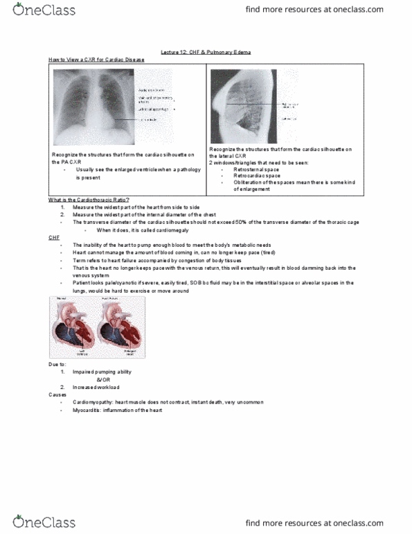 MEDRADSC 3J03 Lecture Notes - Lecture 12: Rib Cage, Cardiomegaly, Myocarditis thumbnail