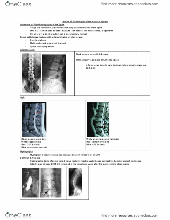 MEDRADSC 3J03 Lecture Notes - Lecture 18: Spinal Disc Herniation, Myelography, Subarachnoid Space thumbnail