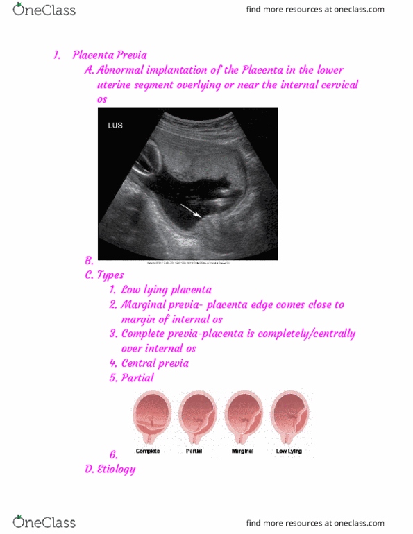 RIU 332 Lecture Notes - Lecture 55: Placenta Praevia, Cervical Canal, Etiology thumbnail