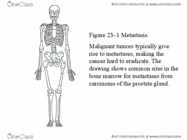 BIOC 212 Lecture Notes - Lecture 27: Prostate, Stomach Cancer, Melanoma thumbnail